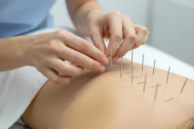 Acupuncture specialists for Ehlers-Danlos Syndrome